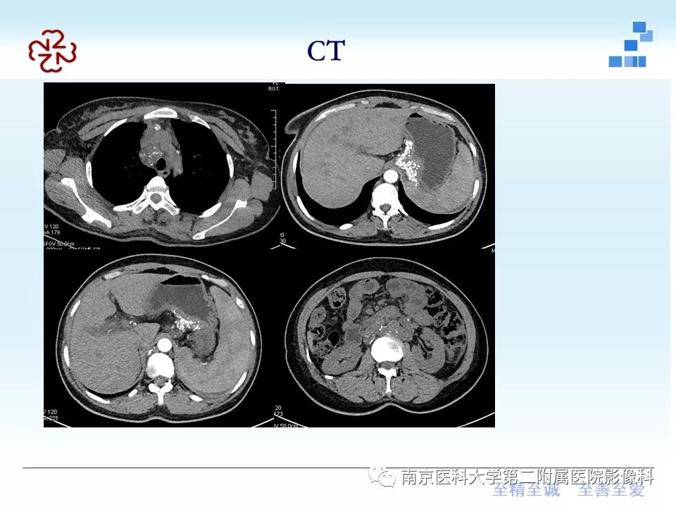 【PPT】胃黏液腺癌的多层螺旋CT表现