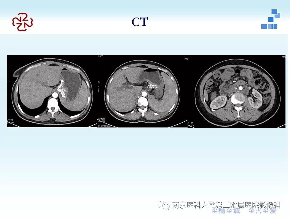 【PPT】胃黏液腺癌的多层螺旋CT表现
