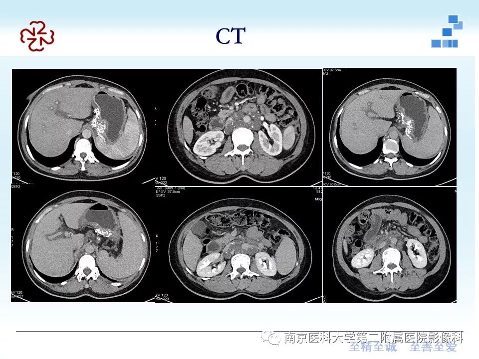 【PPT】胃黏液腺癌的多层螺旋CT表现