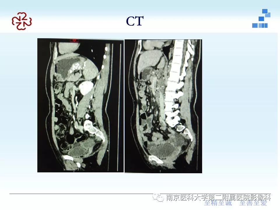 【PPT】胃黏液腺癌的多层螺旋CT表现