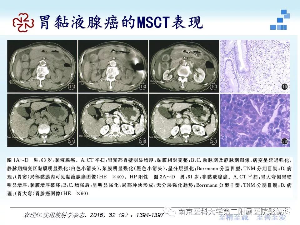 【PPT】胃黏液腺癌的多层螺旋CT表现