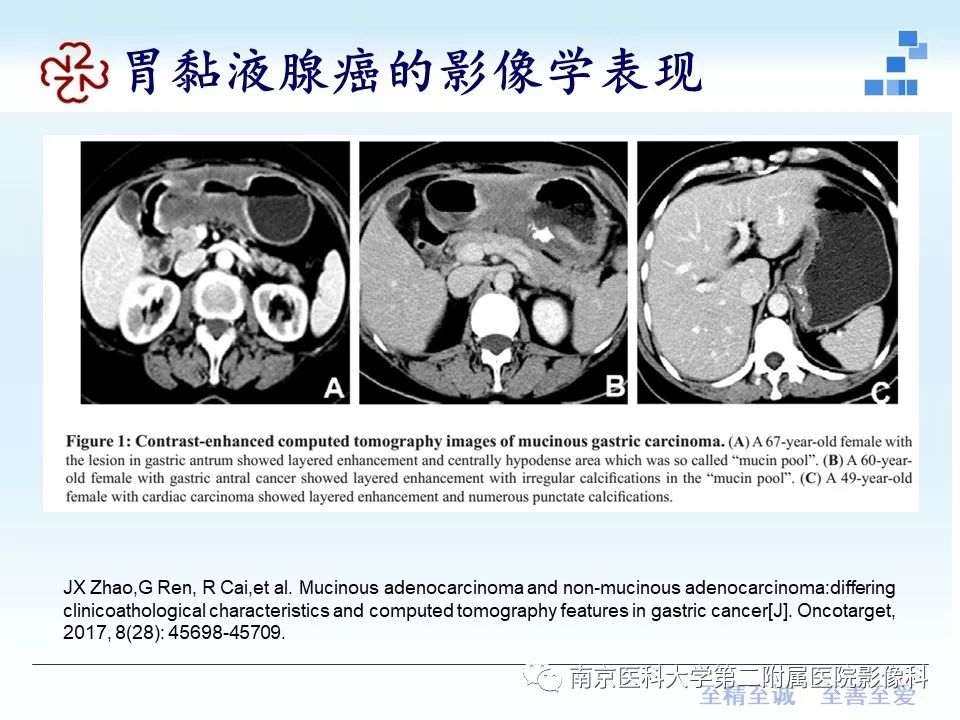 【PPT】胃黏液腺癌的多层螺旋CT表现