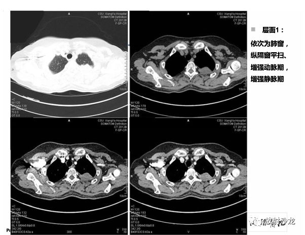 【病例】胸膜结核性肉芽肿1例CT