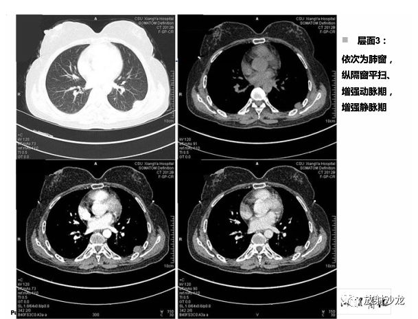 【病例】胸膜结核性肉芽肿1例CT