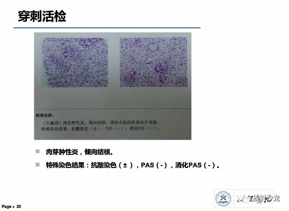【病例】胸膜结核性肉芽肿1例CT