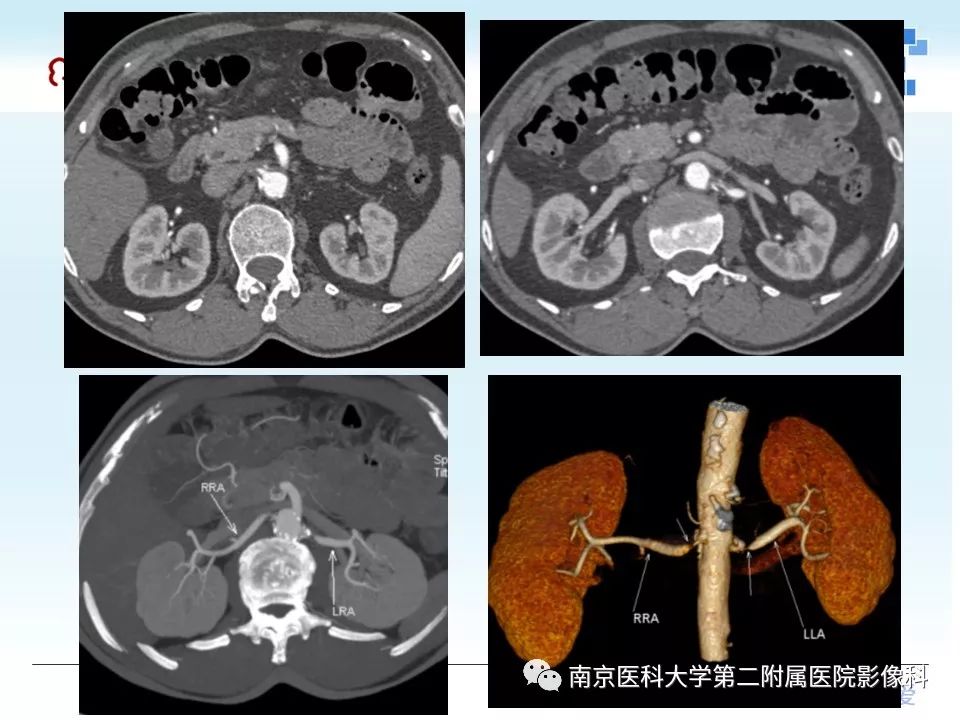 【PPT】肾血管性疾病