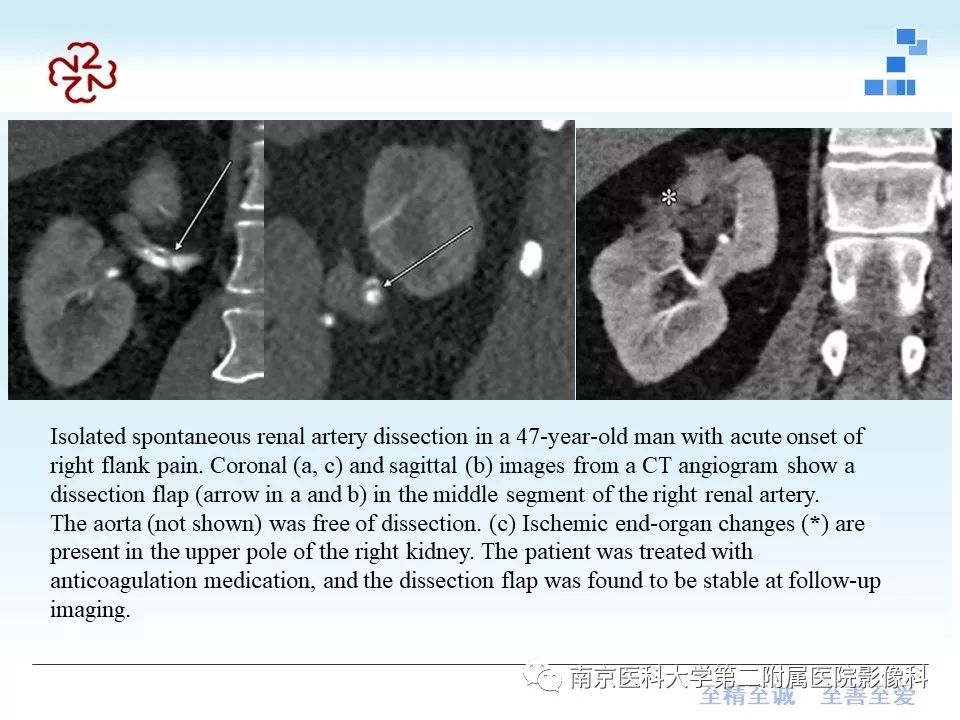 【PPT】肾血管性疾病