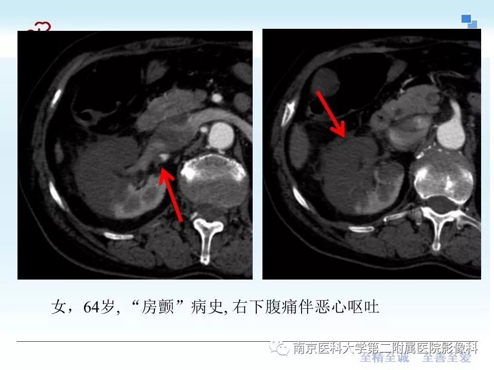 【PPT】肾血管性疾病