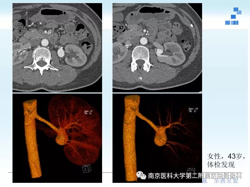 【PPT】肾血管性疾病