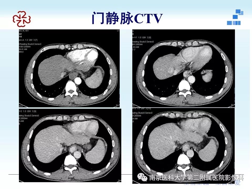 【PPT】肝硬化结节