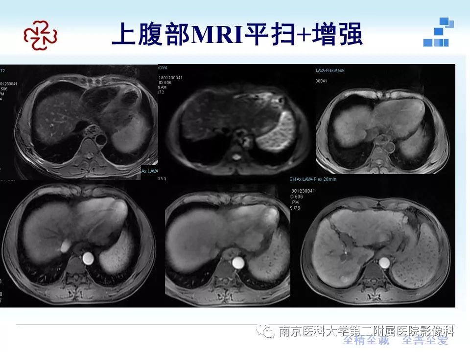 【PPT】肝硬化结节