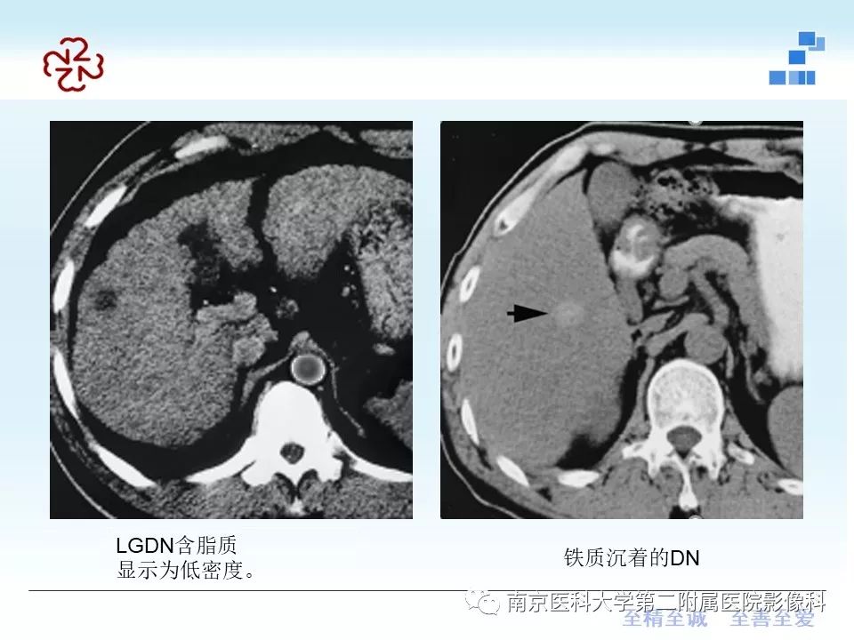 【PPT】肝硬化结节