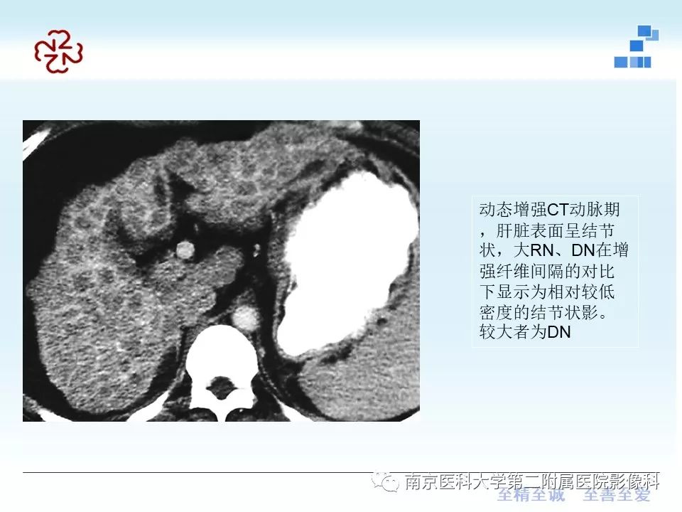 【PPT】肝硬化结节