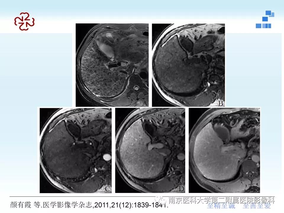 【PPT】肝硬化结节