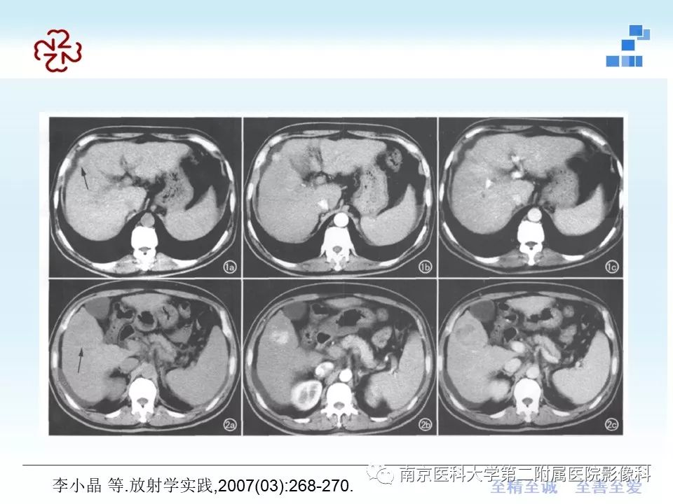 【PPT】肝硬化结节
