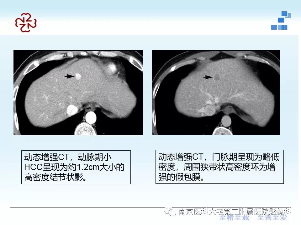 【PPT】肝硬化结节