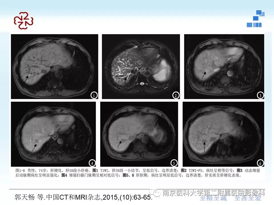 【PPT】肝硬化结节