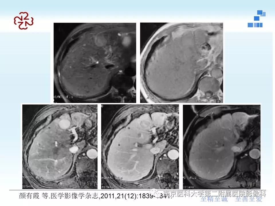 【PPT】肝硬化结节