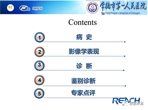 【病例】骶孔脊膜瘤1例MR影像表现
