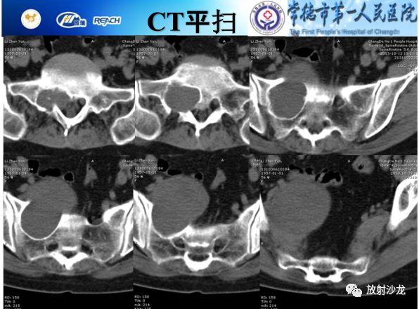 【病例】骶孔脊膜瘤1例MR影像表现