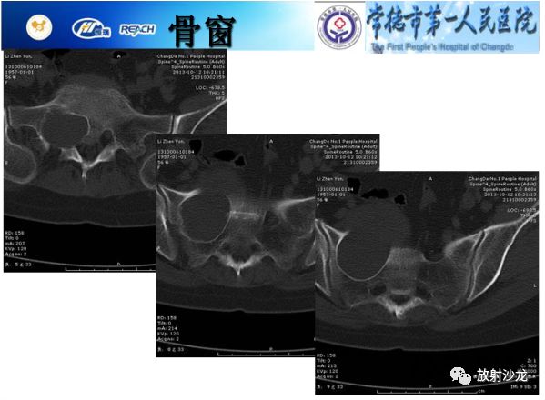 【病例】骶孔脊膜瘤1例MR影像表现