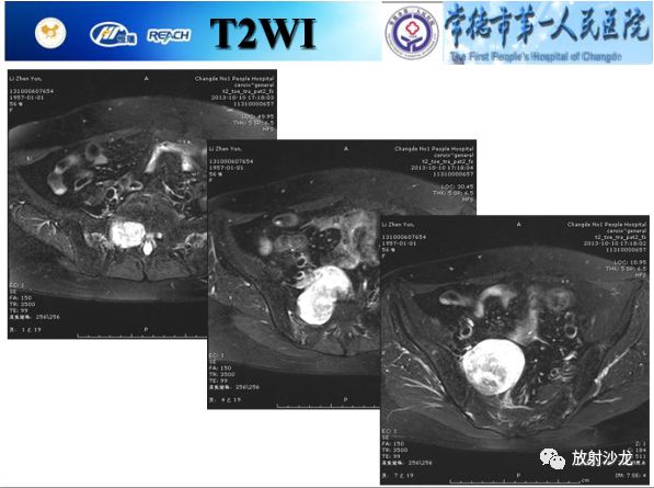 【病例】骶孔脊膜瘤1例MR影像表现