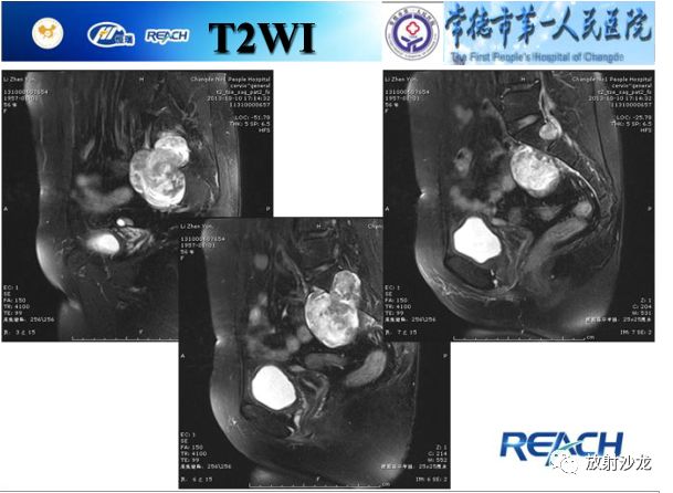【病例】骶孔脊膜瘤1例MR影像表现