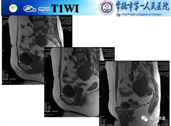 【病例】骶孔脊膜瘤1例MR影像表现