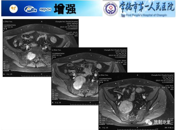 【病例】骶孔脊膜瘤1例MR影像表现