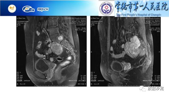 【病例】骶孔脊膜瘤1例MR影像表现