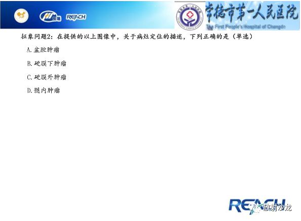 【病例】骶孔脊膜瘤1例MR影像表现