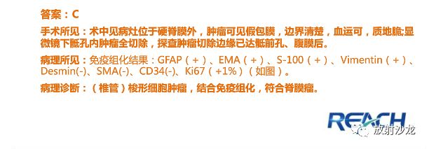 【病例】骶孔脊膜瘤1例MR影像表现