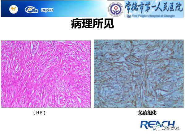 【病例】骶孔脊膜瘤1例MR影像表现