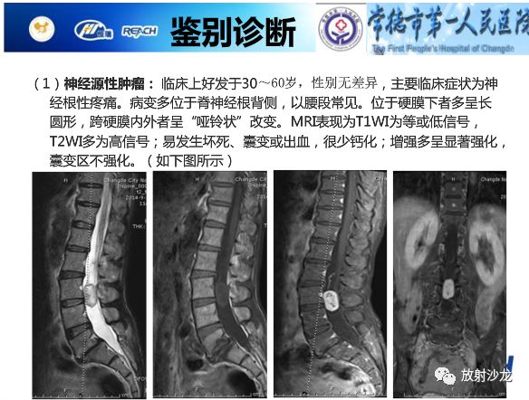 【病例】骶孔脊膜瘤1例MR影像表现