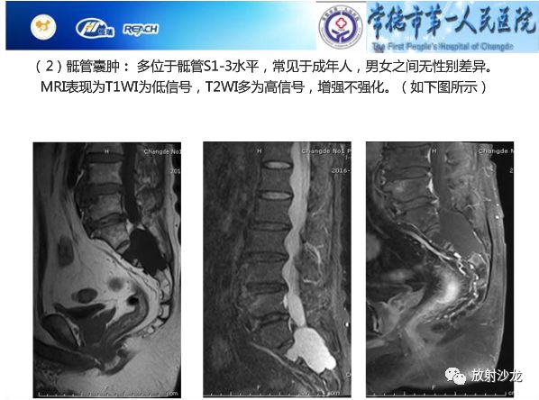 【病例】骶孔脊膜瘤1例MR影像表现