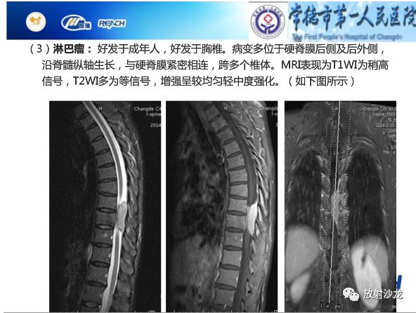 【病例】骶孔脊膜瘤1例MR影像表现