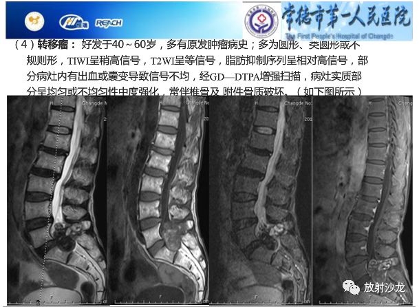 【病例】骶孔脊膜瘤1例MR影像表现
