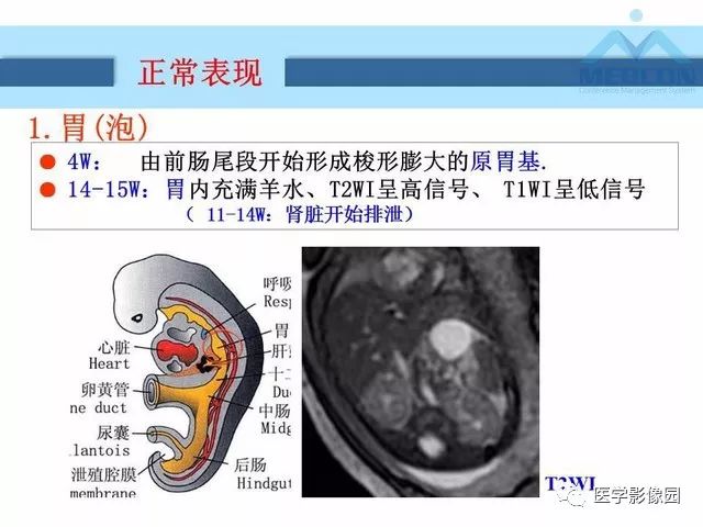 【PPT】胎儿肠梗阻：MRI表现与分析
