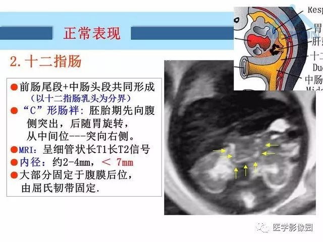 【PPT】胎儿肠梗阻：MRI表现与分析
