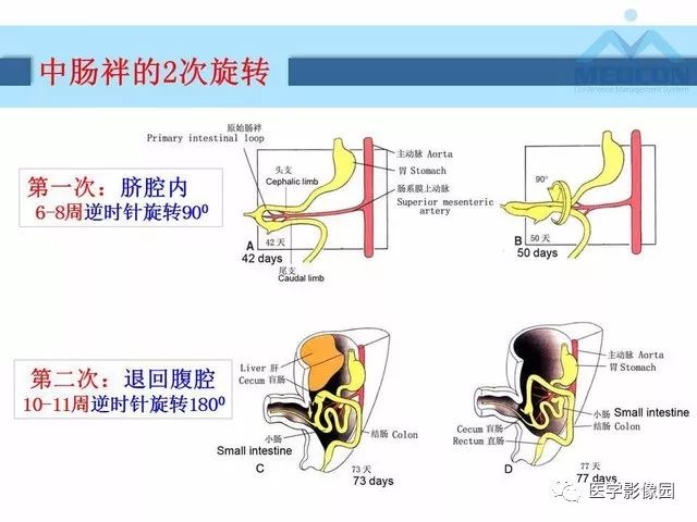【PPT】胎儿肠梗阻：MRI表现与分析