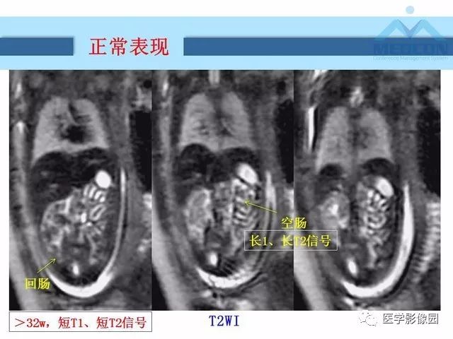 【PPT】胎儿肠梗阻：MRI表现与分析