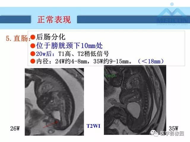 【PPT】胎儿肠梗阻：MRI表现与分析