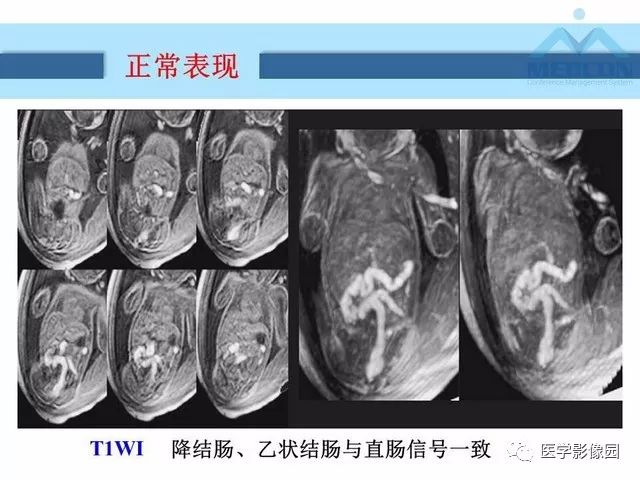 【PPT】胎儿肠梗阻：MRI表现与分析