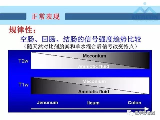 【PPT】胎儿肠梗阻：MRI表现与分析