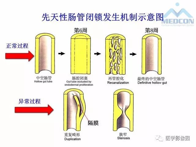 【PPT】胎儿肠梗阻：MRI表现与分析