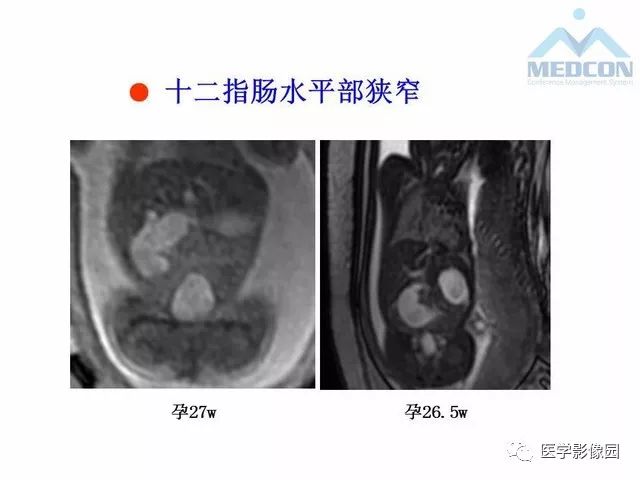 【PPT】胎儿肠梗阻：MRI表现与分析