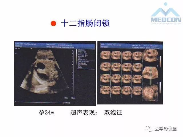 【PPT】胎儿肠梗阻：MRI表现与分析
