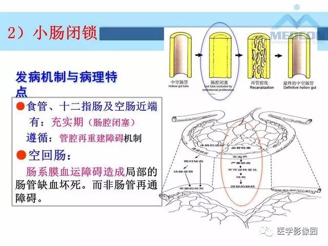 【PPT】胎儿肠梗阻：MRI表现与分析