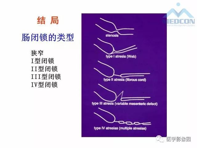【PPT】胎儿肠梗阻：MRI表现与分析