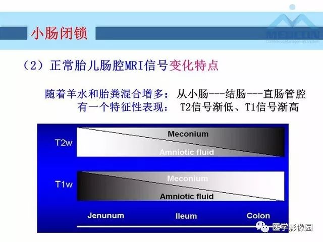 【PPT】胎儿肠梗阻：MRI表现与分析